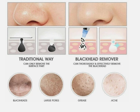 Limpiador Eléctrico De Poros Profundo